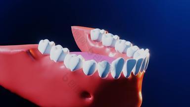 牙医疗牙科植入物过程